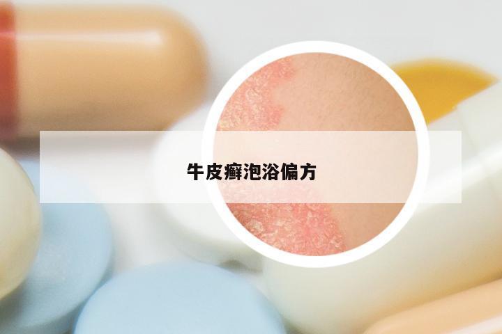 牛皮癣泡浴偏方