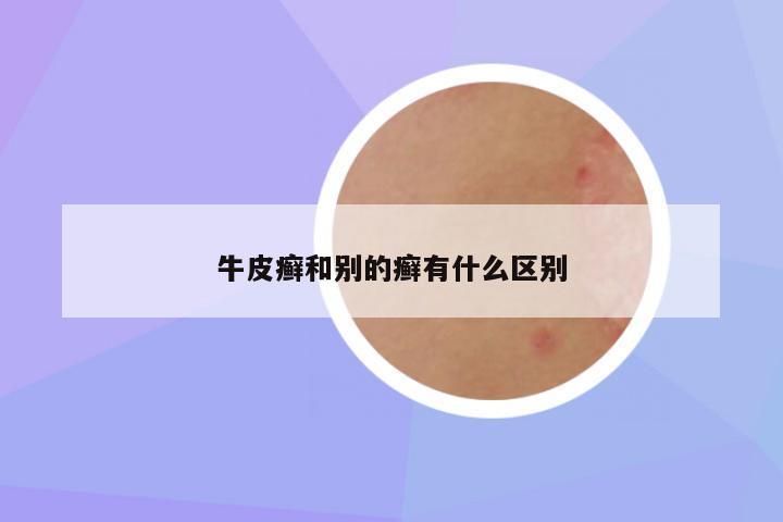 牛皮癣和别的癣有什么区别