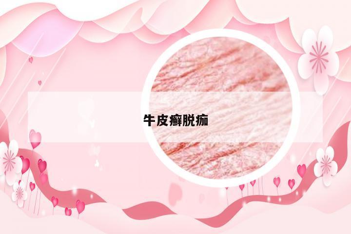 牛皮癣脱痂