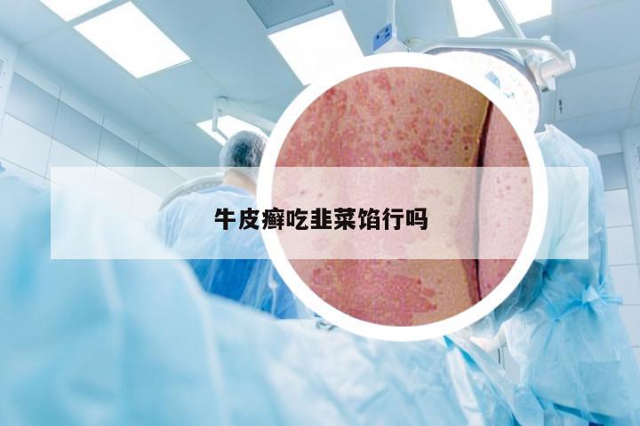 牛皮癣吃韭菜馅行吗