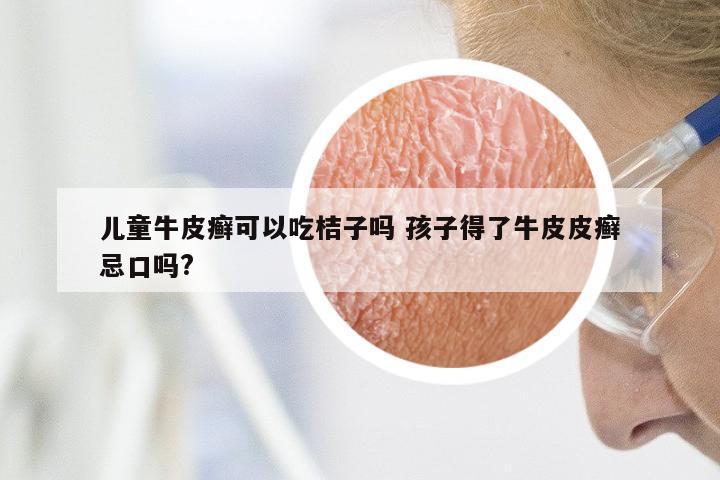 儿童牛皮癣可以吃桔子吗 孩子得了牛皮皮癣忌口吗?