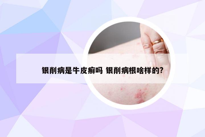 银削病是牛皮癣吗 银削病根啥样的?