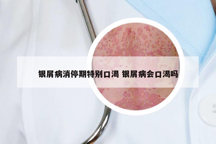 银屑病消停期特别口渴 银屑病会口渴吗