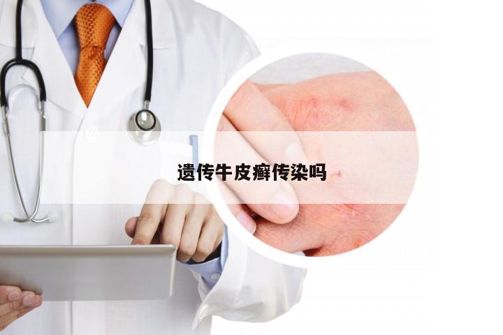遗传牛皮癣传染吗