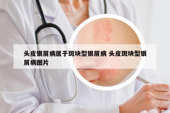 头皮银屑病属于斑块型银屑病 头皮斑块型银屑病图片