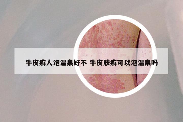 牛皮癣人泡温泉好不 牛皮肤癣可以泡温泉吗
