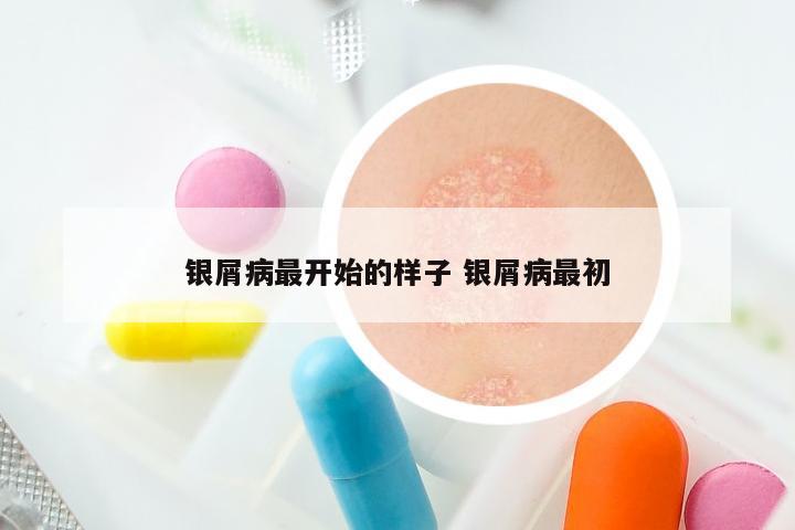 银屑病最开始的样子 银屑病最初