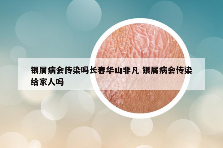 银屑病会传染吗长春华山非凡 银屑病会传染给家人吗