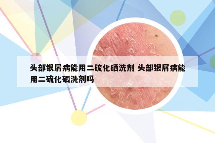 头部银屑病能用二硫化硒洗剂 头部银屑病能用二硫化硒洗剂吗