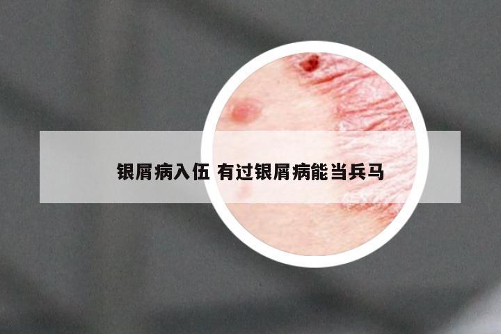 银屑病入伍 有过银屑病能当兵马