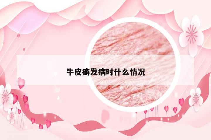 牛皮癣发病时什么情况
