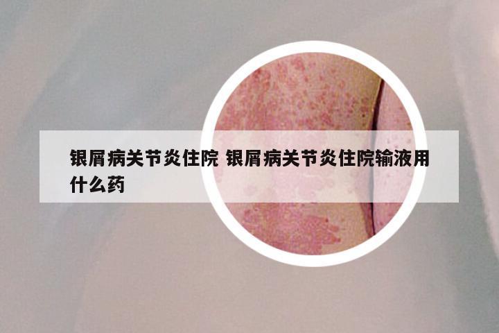 银屑病关节炎住院 银屑病关节炎住院输液用什么药