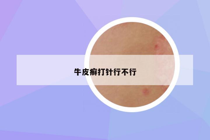 牛皮癣打针行不行