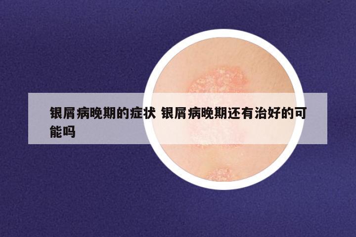 银屑病晚期的症状 银屑病晚期还有治好的可能吗