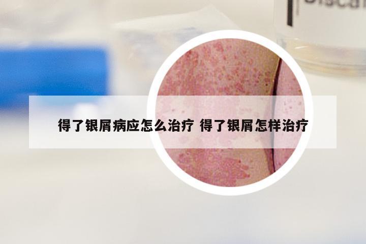 得了银屑病应怎么治疗 得了银屑怎样治疗