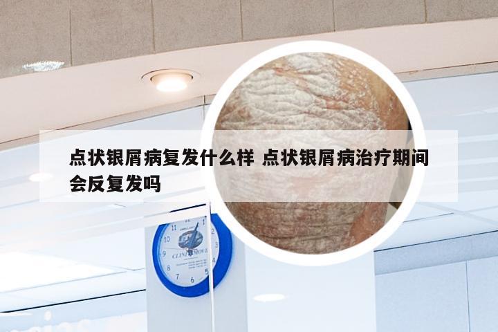 点状银屑病复发什么样 点状银屑病治疗期间会反复发吗