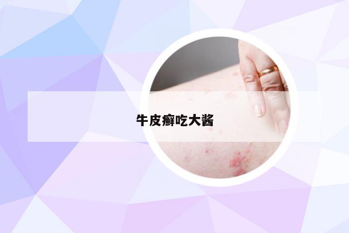 牛皮癣吃大酱