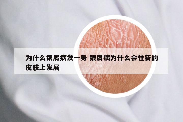 为什么银屑病发一身 银屑病为什么会往新的皮肤上发展