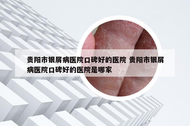 贵阳市银屑病医院口碑好的医院 贵阳市银屑病医院口碑好的医院是哪家