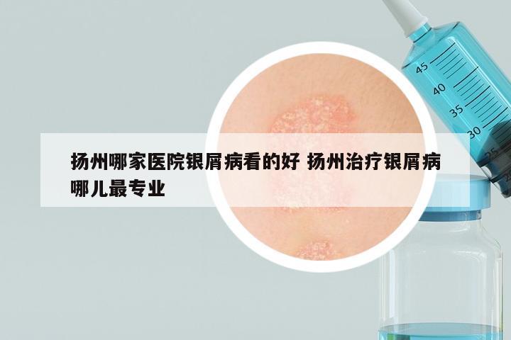 扬州哪家医院银屑病看的好 扬州治疗银屑病哪儿最专业