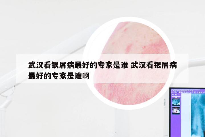 武汉看银屑病最好的专家是谁 武汉看银屑病最好的专家是谁啊