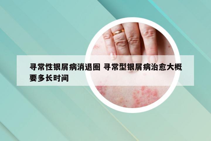 寻常性银屑病消退圈 寻常型银屑病治愈大概要多长时间