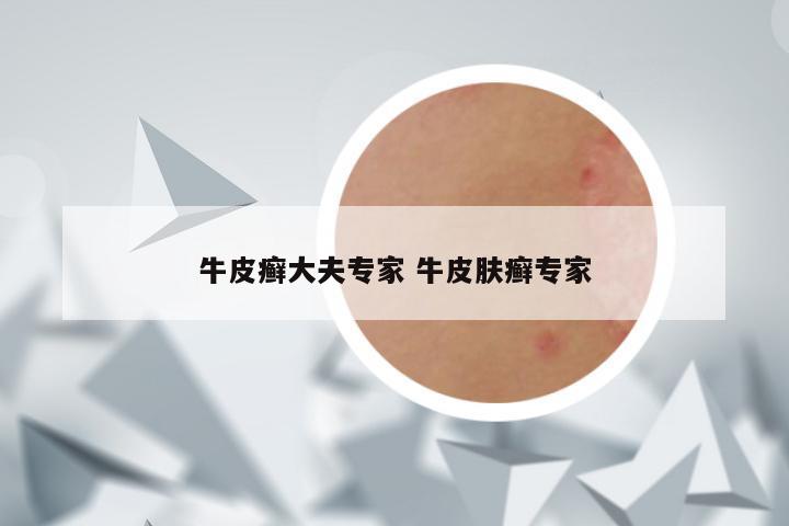 牛皮癣大夫专家 牛皮肤癣专家