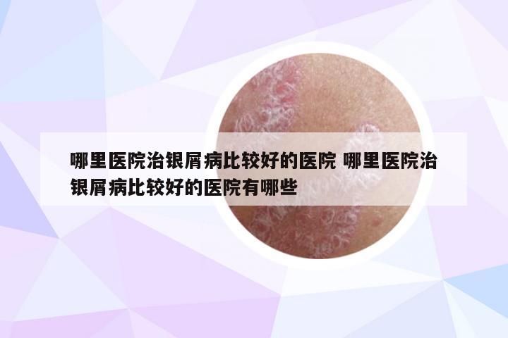 哪里医院治银屑病比较好的医院 哪里医院治银屑病比较好的医院有哪些