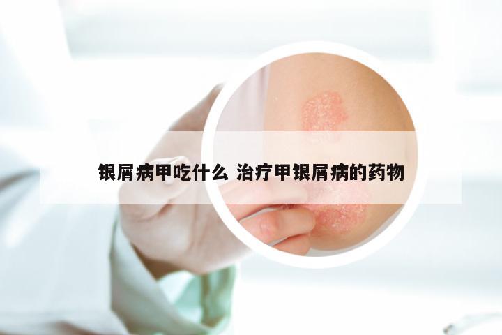 银屑病甲吃什么 治疗甲银屑病的药物