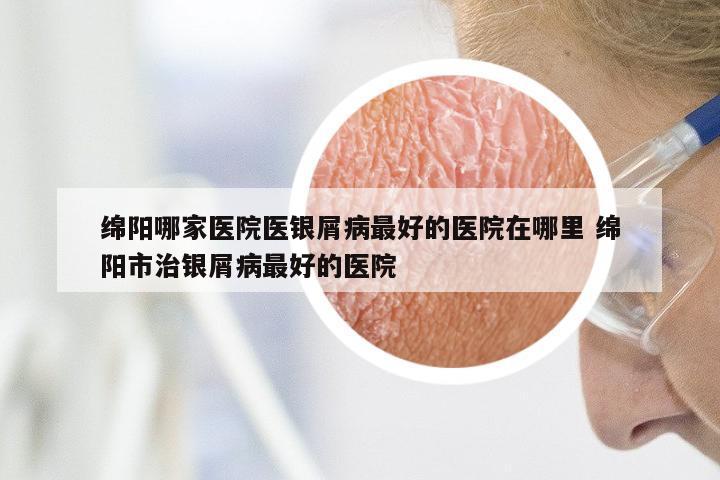 绵阳哪家医院医银屑病最好的医院在哪里 绵阳市治银屑病最好的医院