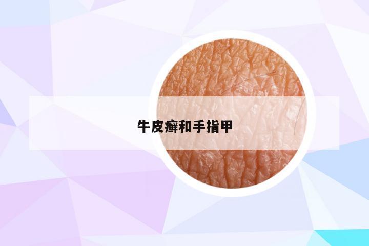 牛皮癣和手指甲