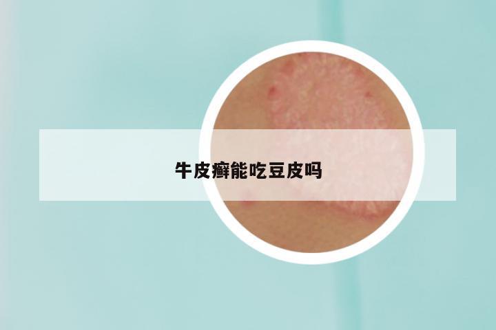 牛皮癣能吃豆皮吗