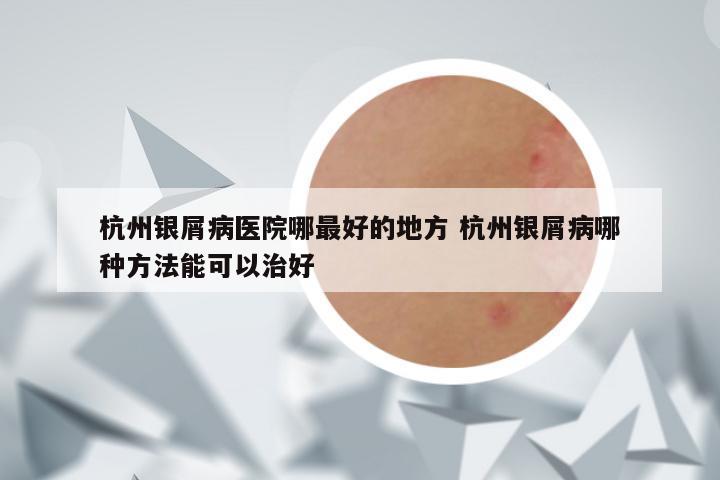 杭州银屑病医院哪最好的地方 杭州银屑病哪种方法能可以治好