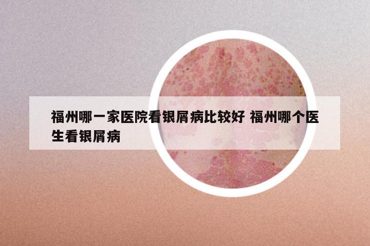 福州哪一家医院看银屑病比较好 福州哪个医生看银屑病
