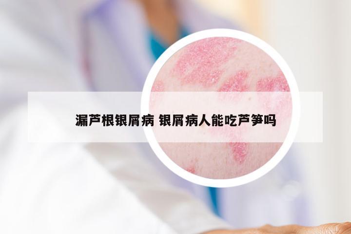 漏芦根银屑病 银屑病人能吃芦笋吗