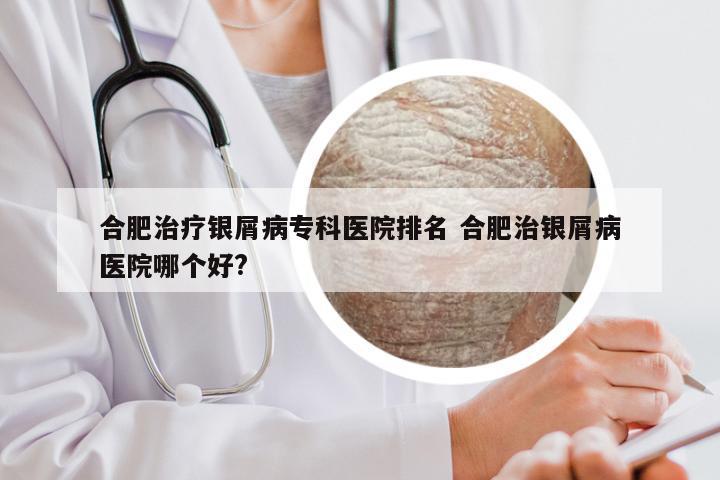 合肥治疗银屑病专科医院排名 合肥治银屑病医院哪个好?