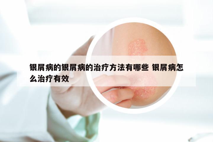 银屑病的银屑病的治疗方法有哪些 银屑病怎么治疗有效