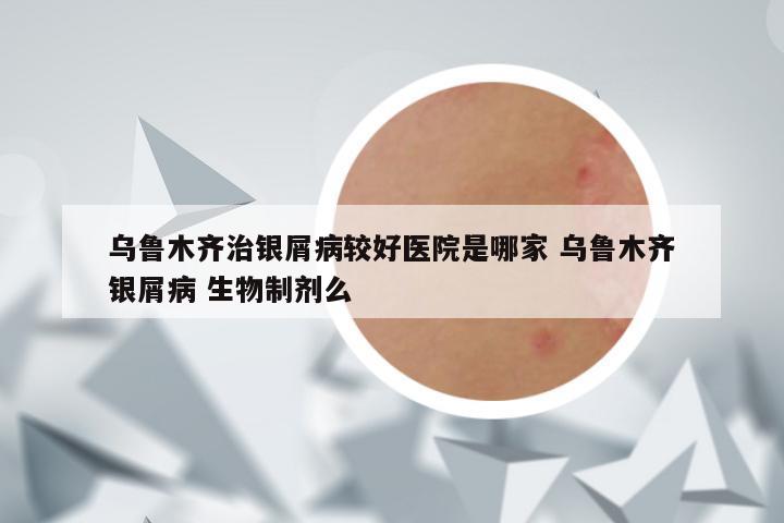 乌鲁木齐治银屑病较好医院是哪家 乌鲁木齐银屑病 生物制剂么