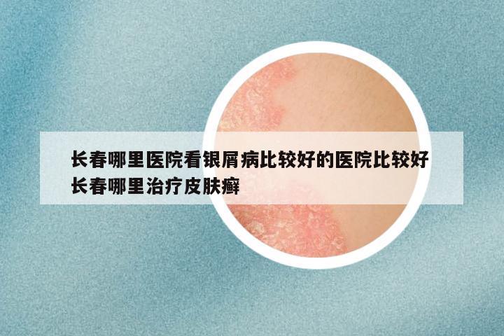 长春哪里医院看银屑病比较好的医院比较好 长春哪里治疗皮肤癣