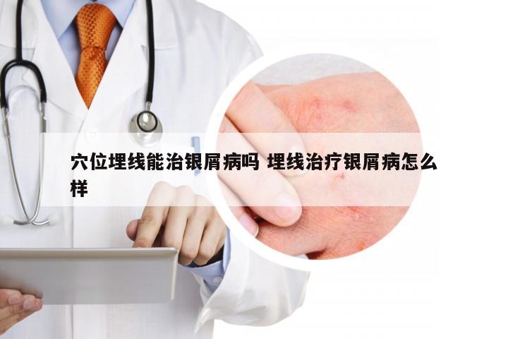 穴位埋线能治银屑病吗 埋线治疗银屑病怎么样