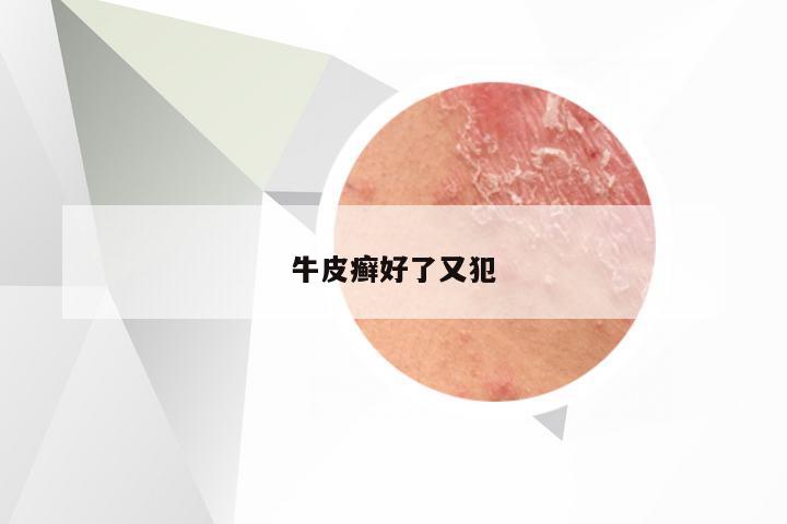 牛皮癣好了又犯