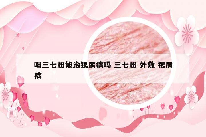 喝三七粉能治银屑病吗 三七粉 外敷 银屑病