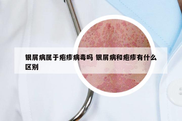 银屑病属于疱疹病毒吗 银屑病和疱疹有什么区别