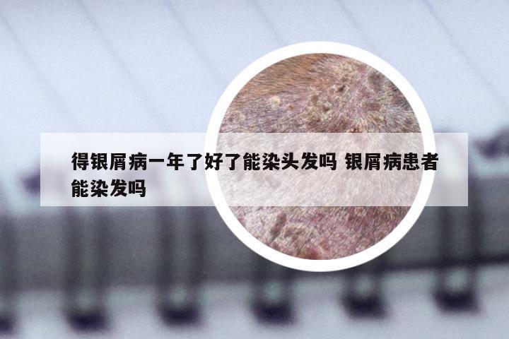 得银屑病一年了好了能染头发吗 银屑病患者能染发吗