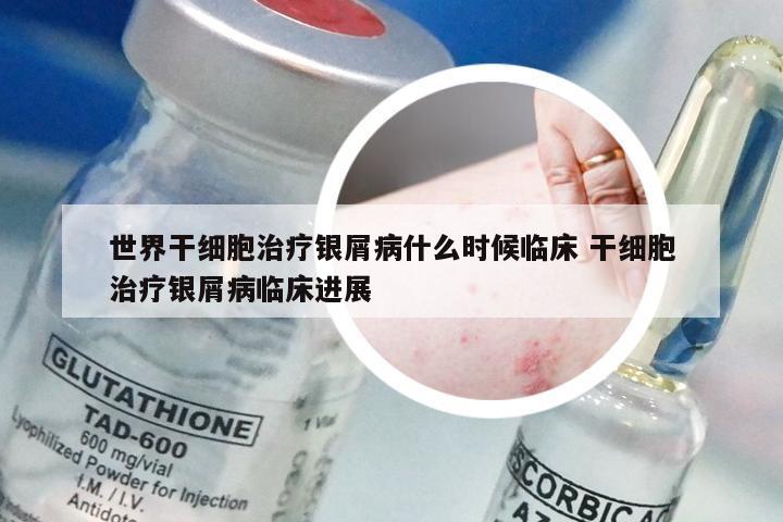 世界干细胞治疗银屑病什么时候临床 干细胞治疗银屑病临床进展