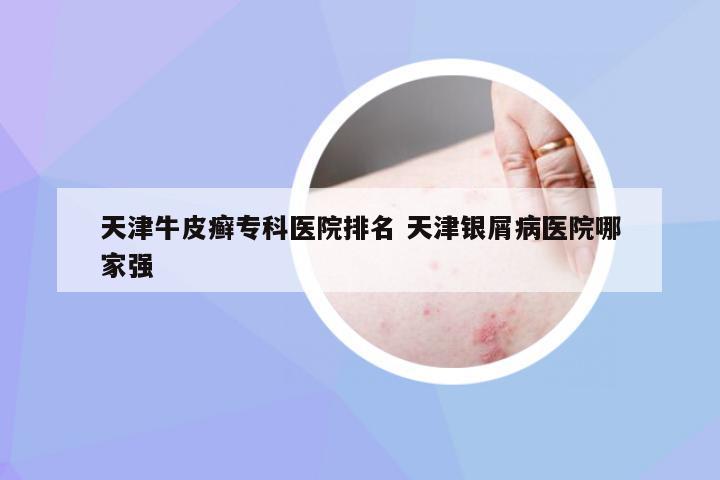 天津牛皮癣专科医院排名 天津银屑病医院哪家强