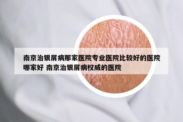 南京治银屑病那家医院专业医院比较好的医院哪家好 南京治银屑病权威的医院