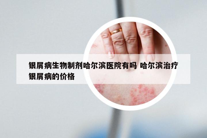 银屑病生物制剂哈尔滨医院有吗 哈尔滨治疗银屑病的价格