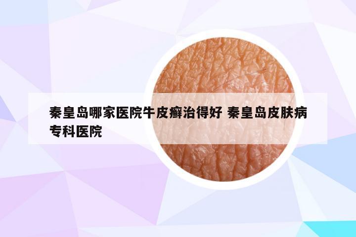 秦皇岛哪家医院牛皮癣治得好 秦皇岛皮肤病专科医院