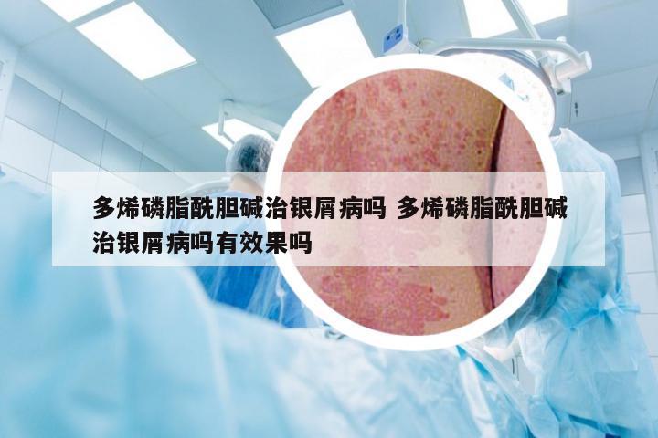 多烯磷脂酰胆碱治银屑病吗 多烯磷脂酰胆碱治银屑病吗有效果吗